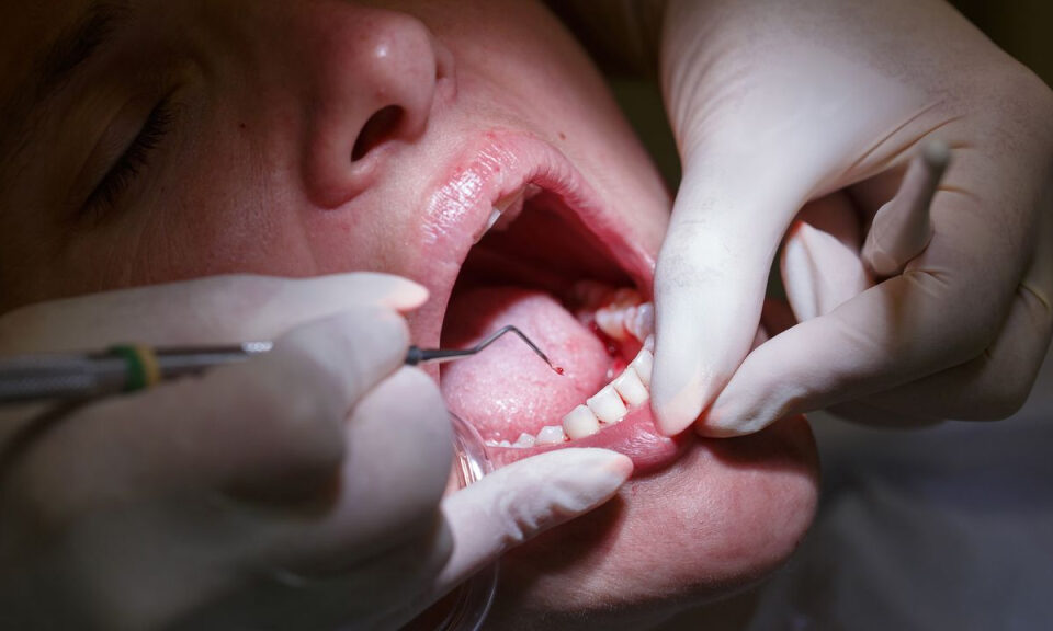 Una sigilosa bacteria podría esconderse en tus encías y causar daños cardíacos