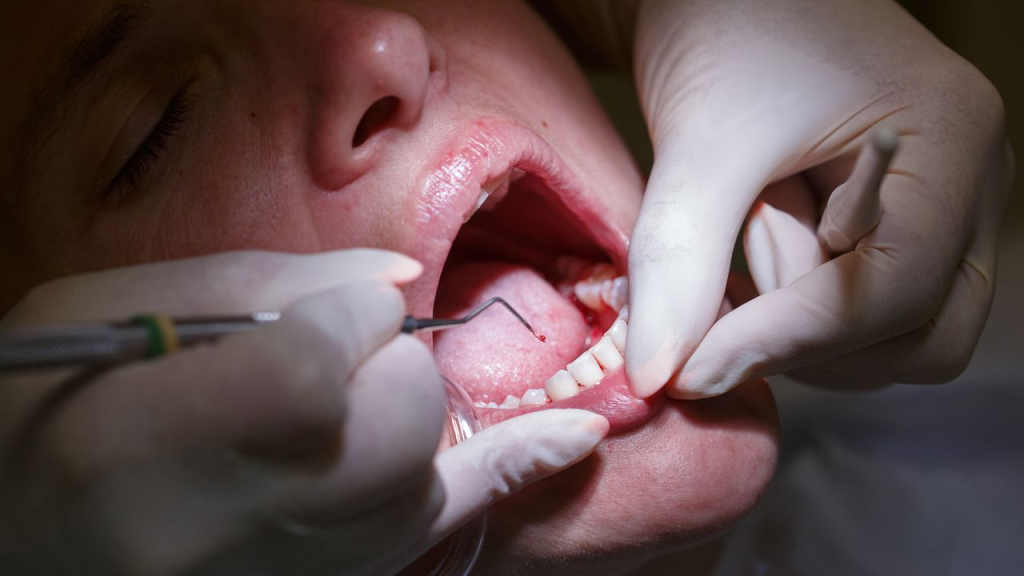 Una sigilosa bacteria podría esconderse en tus encías y causar daños cardíacos