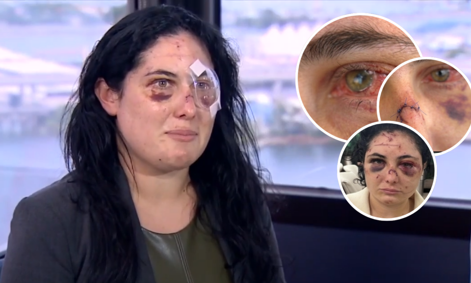 Mujer apuñalada con bolígrafo en Downtown Miami quedó parcialmente ciega