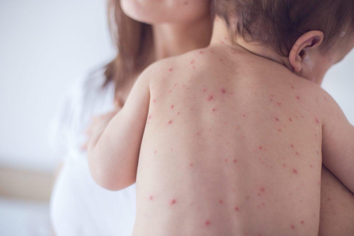 Los síntomas del sarampión incluyen tos, secreción nasal, ojos rojos e inflamados, dolor de garganta, fiebre y su característico sarpullido con manchas.